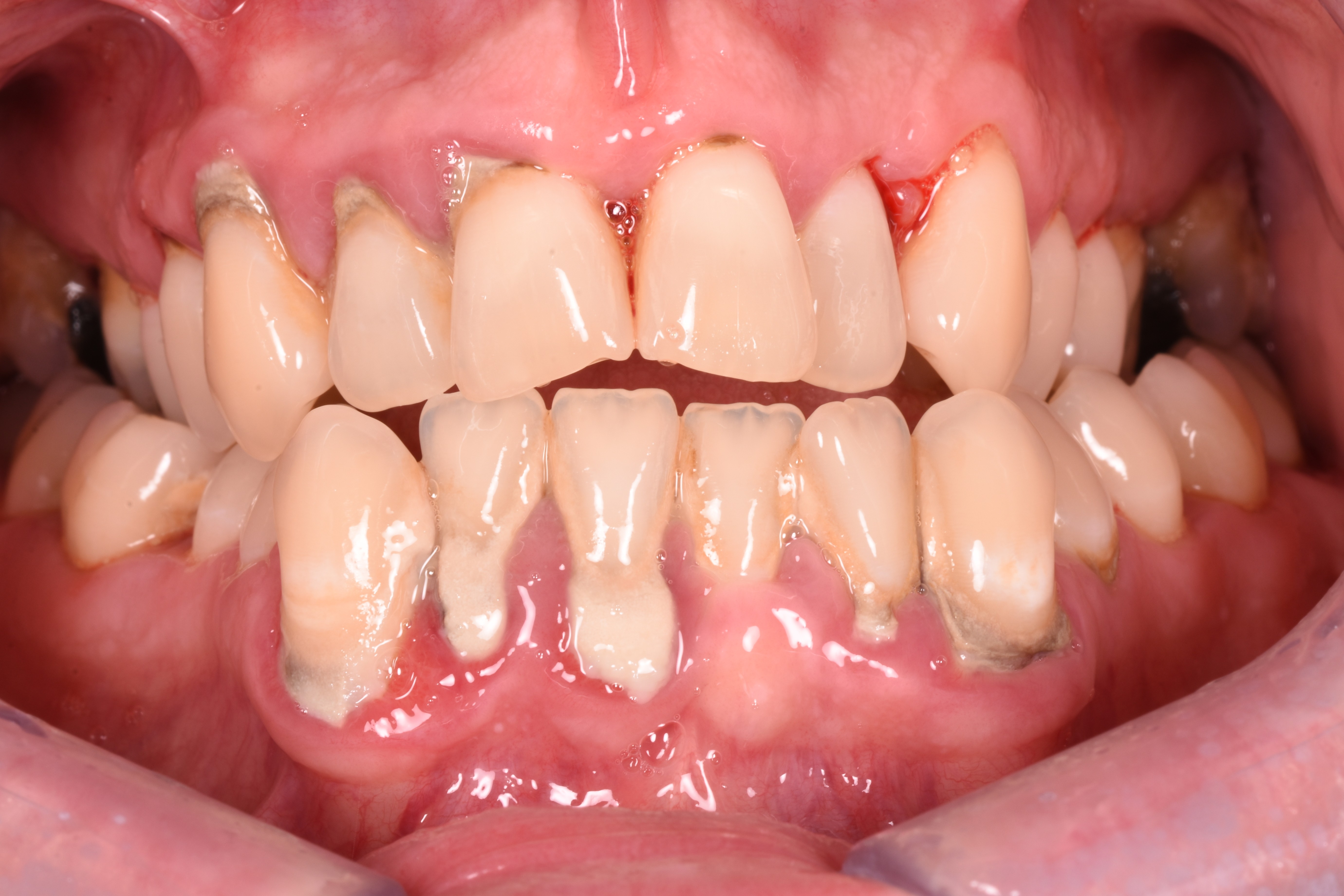 Periodontal Disease before treatment